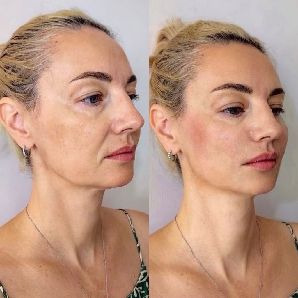 SMAS лифтинг или 7D 